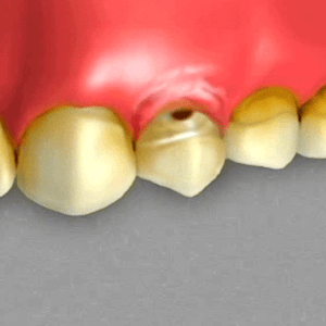Abscessed Tooth Abscessed Tooth
